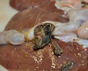 Active liver fluke infection